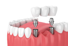 Dental implants