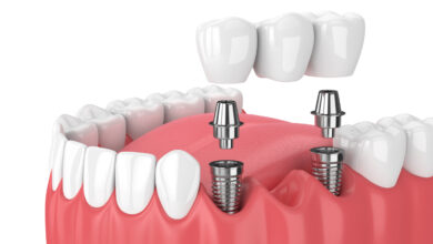 Dental implants