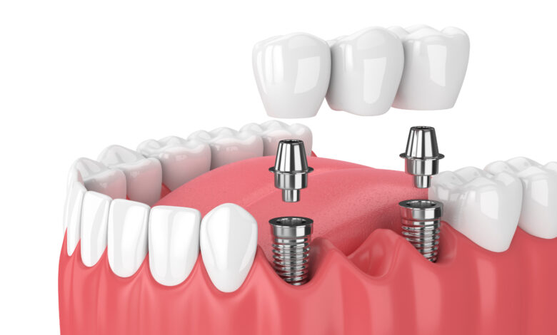 Dental implants